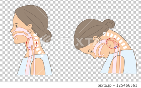 首下がり症と正常な女性の咽頭の比較イラスト 125466363