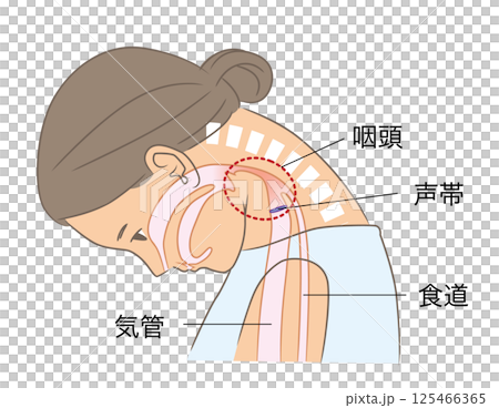 A woman with a narrowed pharynx due to a dropped neck 125466365
