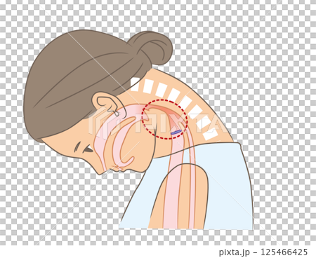 A woman with a narrowed pharynx due to a dropped neck 125466425