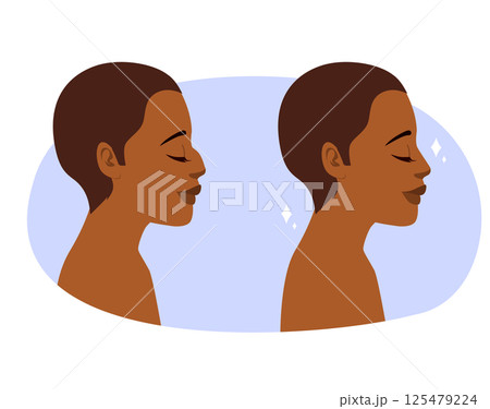 Rhinoplasty Before and After Surgery Woman Profile Cartoon Illustration Rhinoplasty Before and After Surgery Woman Profile Cartoon Illustration 125479224