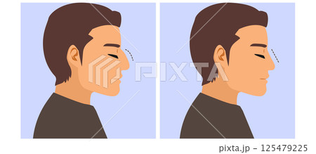 Rhinoplasty Before and After Reconstruction Surgery Man Profile Cartoon Illustration Rhinoplasty Before and After Reconstruction Surgery Man Profile Cartoon Illustration 125479225