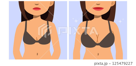 Breast Augmentation Woman Before and After Plastic Surgery Vector Illustration 125479227