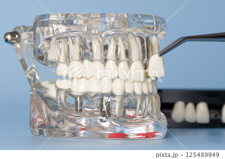 Transparent anatomical dental model showing tooth implants and a veneer being positioned Transparent anatomical dental model showing tooth implants and a veneer being positioned 125489949