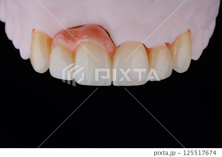 High-quality naturally dental single crowns made of zirconium for fixation to the frontal teeth of upper jaw. 125517674