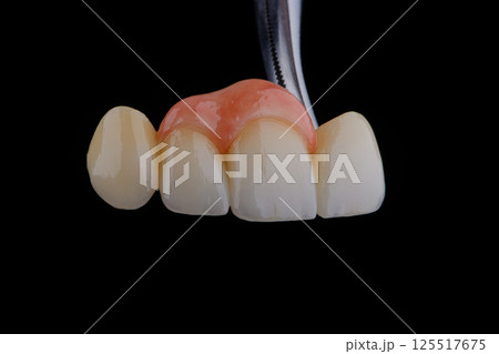 Naturally dental bridge with artificial gum made of zirconium for fixation to frontal upper teeth. 125517675