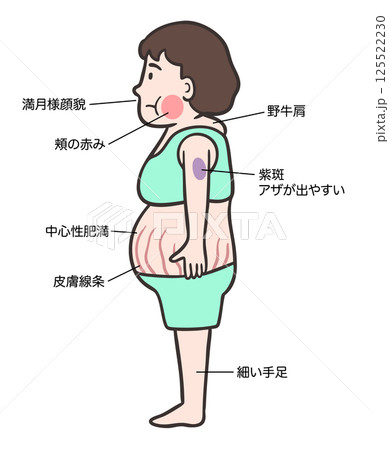 クッシング症候群の女性の側面、 特徴的な体型と症状 125522230