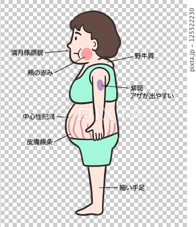 クッシング症候群の女性の側面、 特徴的な体型と症状 125522230