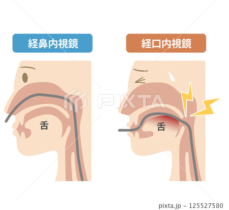胃カメラの鼻から入れる経鼻内視鏡と口から入れる経口内視鏡の違いの説明図 125527580