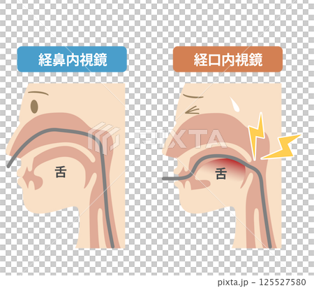 胃カメラの鼻から入れる経鼻内視鏡と口から入れる経口内視鏡の違いの説明図 125527580