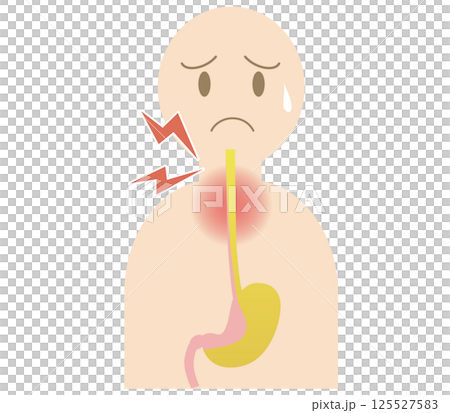 People with gastroesophageal reflux disease who experience a sore throat due to stomach acid reflux 125527583