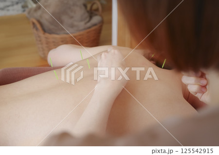 鍼灸院で背中に鍼治療をする女性 125542915