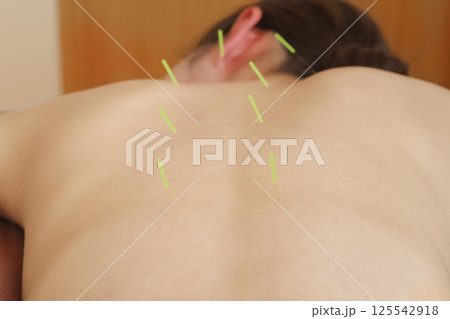 鍼灸院で背中に鍼治療をする女性 125542918