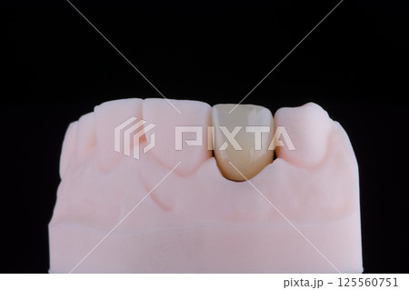 Lateral maxillary incisor made of zirconium, ultra thin dental ceramic veneer crown on printed model 125560751