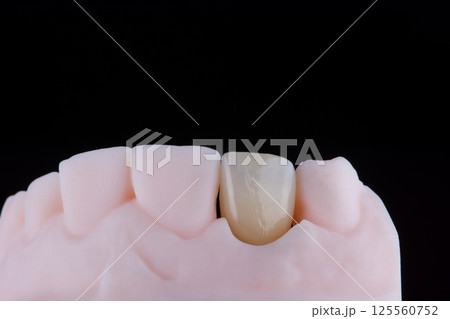 Lateral maxillary incisor made of zirconium, ultra thin dental ceramic veneer crown on printed model 125560752