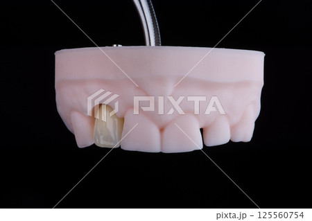 Lateral maxillary incisor made of zirconium, ultra thin dental ceramic veneer crown on printed model 125560754