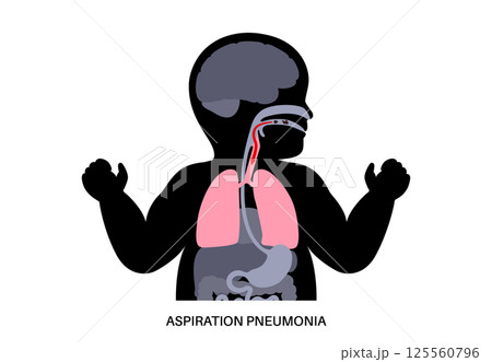 Aspiration pneumonia poster 125560796