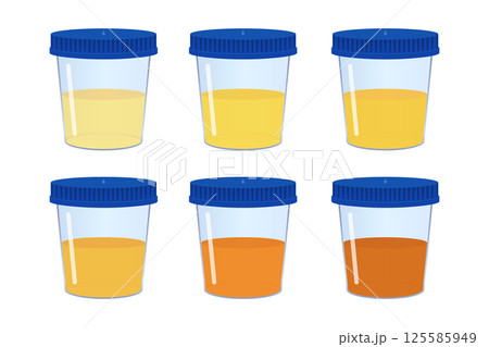 Medical urine test showing different colors. 125585949