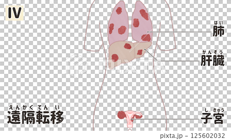 卵巣がん ステージⅣ(4期) わかりやすい日本語図解イラスト 卵巣がん ステージⅣ(4期) わかりやすい日本語図解イラスト 125602032