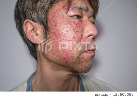 帯状疱疹の症状例 50代男性 帯状疱疹の症状例 50代男性 125605089