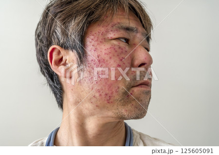 帯状疱疹の症状例　50代男性 125605091