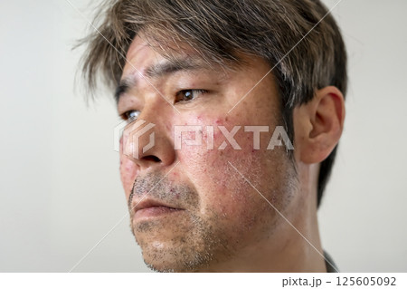 帯状疱疹の症状例 50代男性 帯状疱疹の症状例 50代男性 125605092