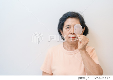 Elderly Woman with eye protective shield after eye surgery. Eye disease, Cataract,  Glaucoma, Age Related Macular Degeneration, Diabetic Retinopathy, Vitreous, Lasik, World Glaucoma day and health 125606357