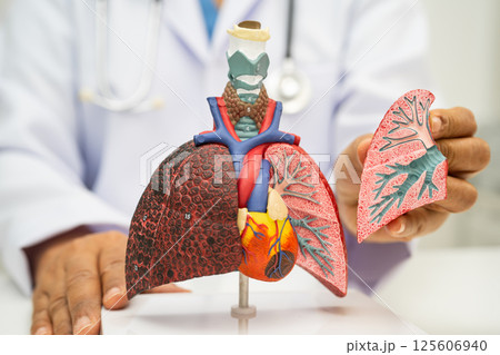 Pneumonia, lung cancer, Asian doctor holding human anatomy model for study diagnosis and treatment in hospital. Pneumonia, lung cancer, Asian doctor holding human anatomy model for study diagnosis and treatment in hospital. 125606940