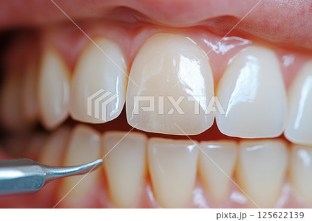 Close-up view of dental veneers showcasing a bright smile in a clinic setting Close-up view of dental veneers showcasing a bright smile in a clinic setting 125622139