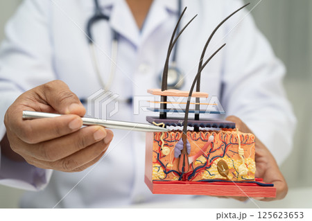 Hair transplant, Asian dermatologist doctor holding skin structure anatomy model for treatment in hospital. Hair transplant, Asian dermatologist doctor holding skin structure anatomy model for treatment in hospital. 125623653
