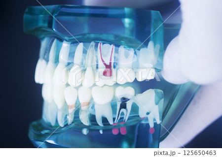 Tooth decay dental model 125650463