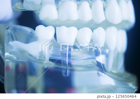 Dental tooth implant model 125650464