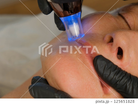 Close-up portrait of a beautiful aged woman during microneedling with dermapen from a beautician. 125651828