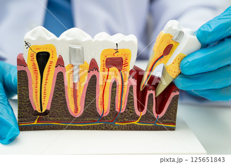 Dental implant, artificial tooth roots into jaw, root canal of dental treatment, gum disease, teeth model for dentist studying about dentistry. Dental implant, artificial tooth roots into jaw, root canal of dental treatment, gum disease, teeth model for dentist studying about dentistry. 125651843