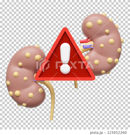 3d Chronic kidney disease or CKD with exclamation mark isolated. danger warning, world kidney day concept, 3d illustration render 3d Chronic kidney disease or CKD with exclamation mark isolated. danger warning, world kidney day concept, 3d illustration render 125652260