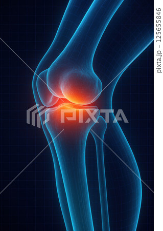 Digital illustration of human knee joint with highlighted inflammation, showcasing anatomy and medical concepts 125655846
