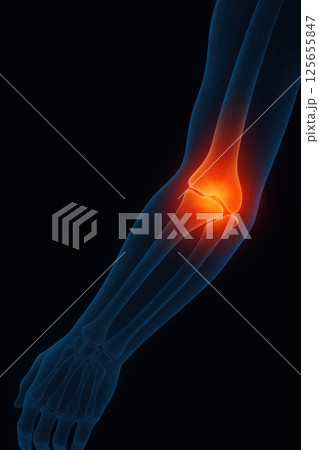 Digital illustration of human arm with highlighted elbow joint, showing inflammation or pain 125655847