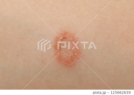 Dermatology disease on human skin. Infection rash, psoriasis, eczema or virus 125662639