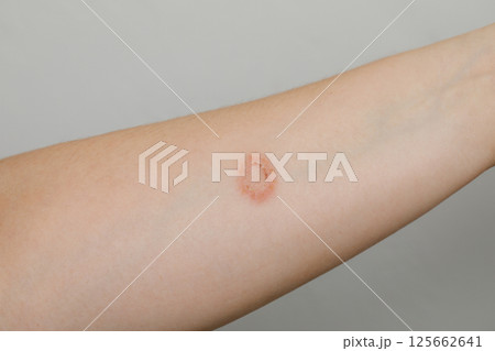 Contact Dermatitis or infection symptom on human skin Contact Dermatitis or infection symptom on human skin 125662641