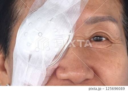 elder woman covering protection on right eye smiling after cataract surgery in blue background elder woman covering protection on right eye smiling after cataract surgery in blue background 125696089
