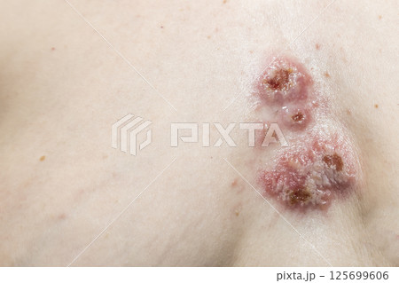 The wounds on the skin in the chest area. Pyoderma on woman body. Complications of the disease with the bacterial infection on skin 125699606