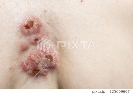 The wounds on the skin in the chest area. Pyoderma on woman body. Complications of the disease with the bacterial infection on skin The wounds on the skin in the chest area. Pyoderma on woman body. Complications of the disease with the bacterial infection on skin 125699607