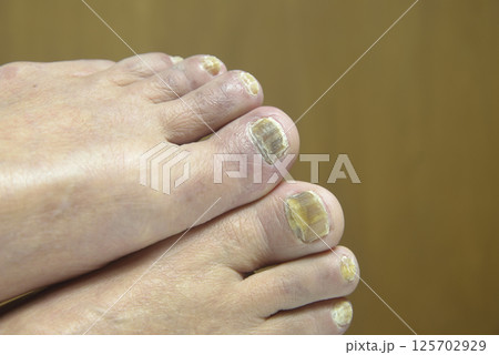 老人足指爪の水虫 125702929