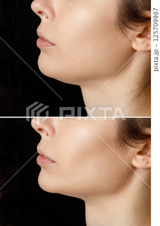 Female double chin before and after correction. Correction of the chin shape liposuction of the neck. The result of the procedure in the clinic of aesthetic ... 125709987