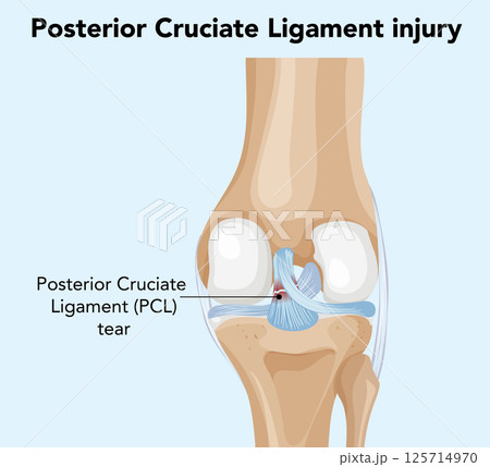 Posterior Cruciate Ligament Injury Illustration 125714970