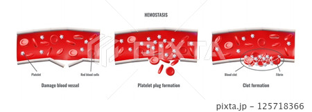 Hemostasis medical 3D infographic vector design, damage blood vessel, platelet plug formation, clot formation processes 125718366