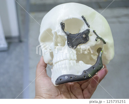 Man holding in hand proto-human skull from white plastic with titanium implants in form of plates and surgical templates printed on 3D printer. Biointegrated prosthesis 125735251