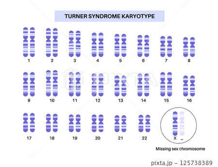 Turner syndrome poster 125738389