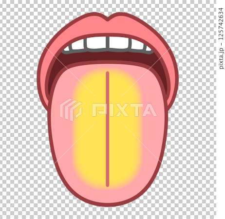 黃舌，舌診，病舌圖 125742634