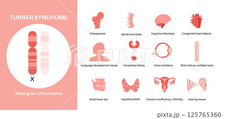 Turner syndrome poster 125765360