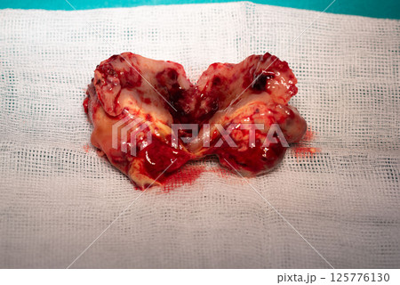 Removed metastatic brain tumor lies on white medical gauze, showcasing surgical procedure Removed metastatic brain tumor lies on white medical gauze, showcasing surgical procedure 125776130